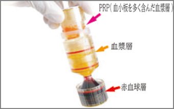 REV MED社製　　Tricell PRP　kit